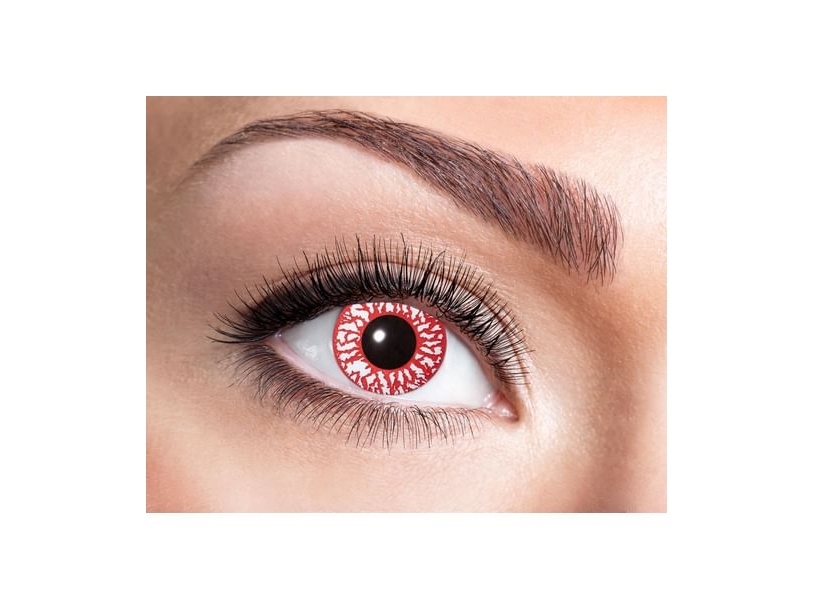 Blutunterlaufene Linsen, 3Md