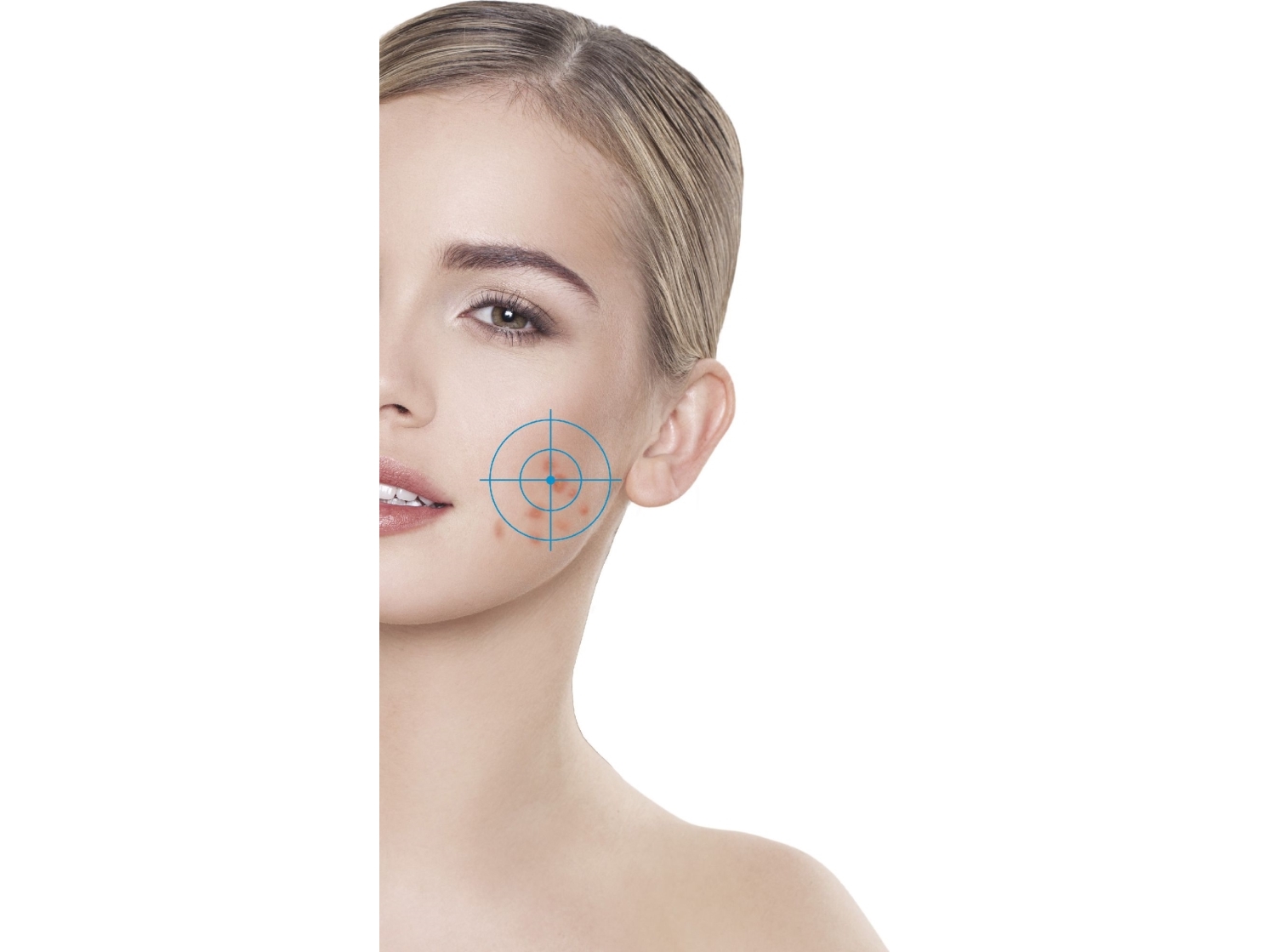 Rio Q-Acne Lite3 Ansigtsrens
