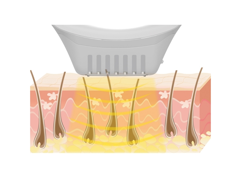 Beurer IPL 10000+ Hårfjerning | Epilatorer | GameStuff